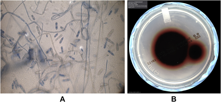 Ochroconis Gallopava Bronchitis Mimicking Haemoptysis In A Patient With 