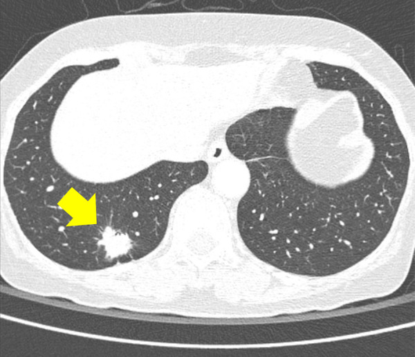 (a) A 64-year-old woman with confirmed lung adenocarcinoma at the right lower lobe (arrow). (b) The lesion, located at the right retrodiaphragmatic area, was missed during routine clinical practice. (c) In the reader performance test, none of the thoracic radiologists detected the lesion. The algorithm successfully localized the lesion (light blue shaded area) with a probability score of 0.16.