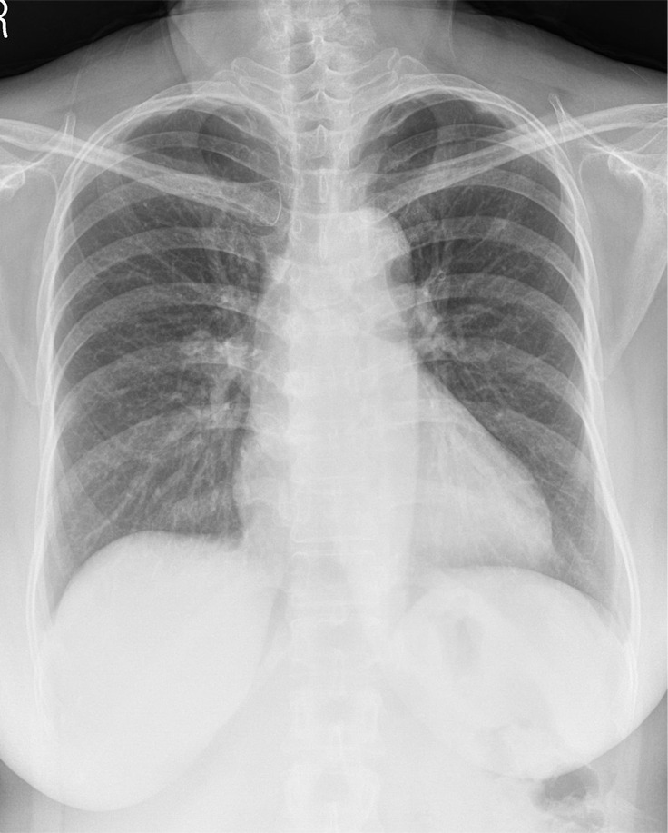 (a) A 57-year-old woman with confirmed lung adenocarcinoma at the right lower lobe (arrow). (b) The lesion, located at the right hilar area, was missed during routine clinical practice. (c) In the reader performance test, all thoracic radiologists detected the lesion. The algorithm also successfully localized the lesion (green shaded area), with a probability score of 0.47.