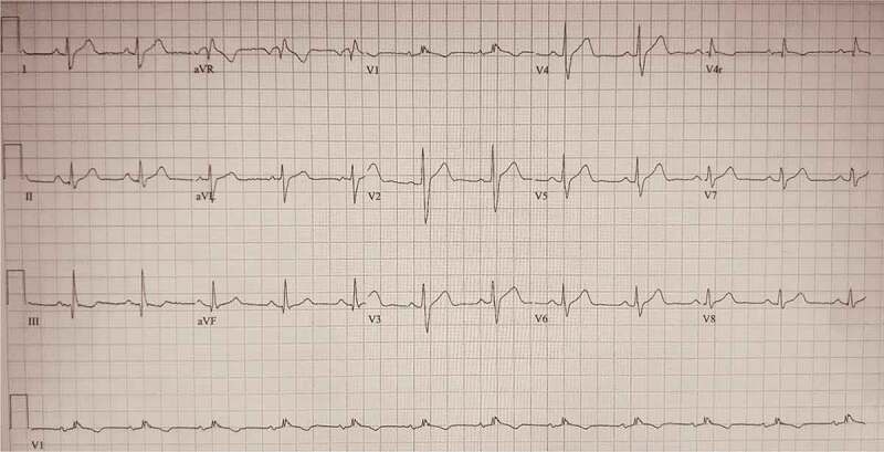 A Stemi Mimic (brugada Ecg Pattern) Unveiled By Influenza Fever - Pmc