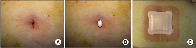 A comparison of the periumbilical incision and the intraumbilical ...