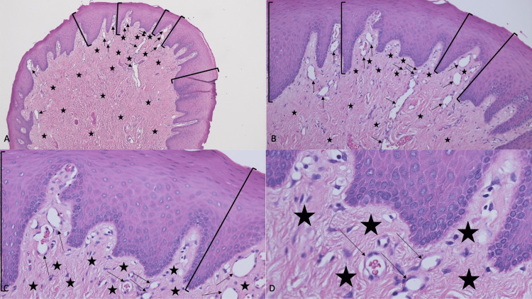 Biting Fibroma of the Lower Lip: A Case Report and Literature Review on ...