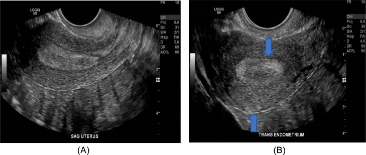 Distinguishing between cornual, angular and interstitial ectopic ...