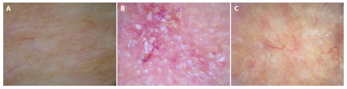 Dermoscopy of Inflammatory Dermatoses (Inflammoscopy): An Up-to-Date ...