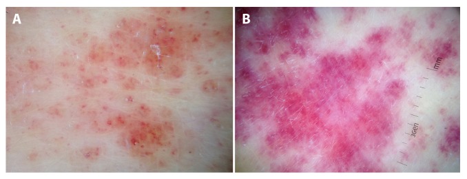 Dermoscopy of Inflammatory Dermatoses (Inflammoscopy): An Up-to-Date ...