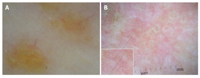 Dermoscopy of Inflammatory Dermatoses (Inflammoscopy): An Up-to-Date ...