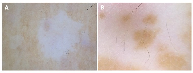 Dermoscopy of Inflammatory Dermatoses (Inflammoscopy): An Up-to-Date ...