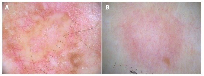 Dermoscopy of Inflammatory Dermatoses (Inflammoscopy): An Up-to-Date ...