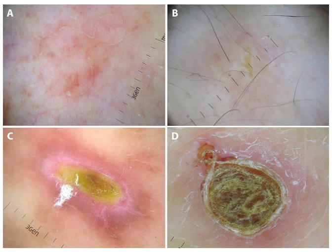 Dermoscopy of Inflammatory Dermatoses (Inflammoscopy): An Up-to-Date ...