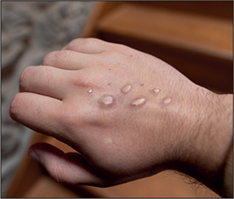 Monkey pox vesicles in a hand