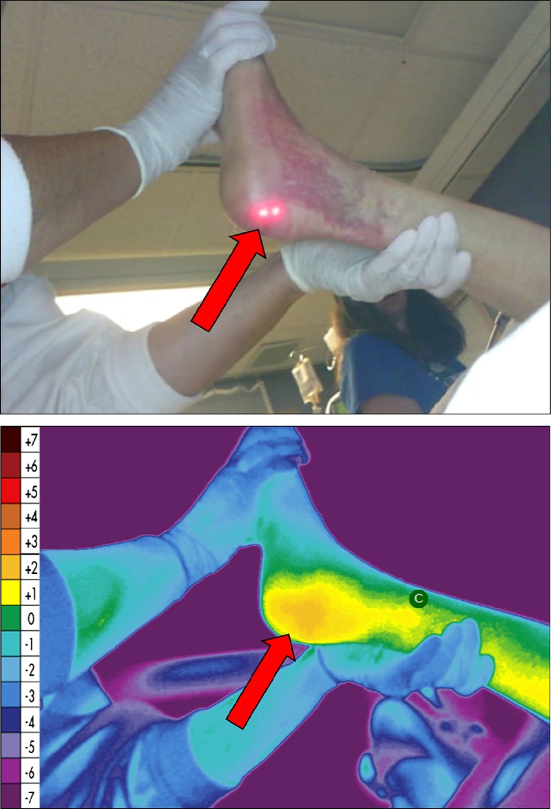 Use of Thermal Imaging to Identify Deep-Tissue Pressure Injury on ...