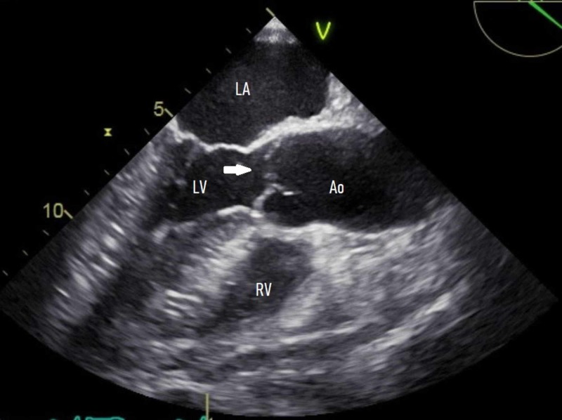 Lambl's Excrescences: An Enigma of Modern Diagnostic Cardiology - PMC