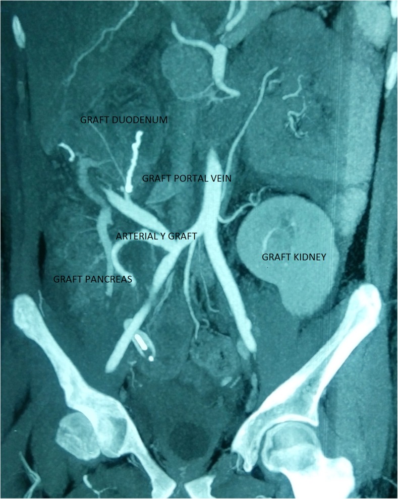 Management of graft duodenal leak in simultaneous pancreas kidney