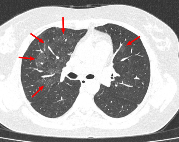 Example of indeterminate CT imaging features for COVID-19 in a 36-year-old female patient. Chest CT image shows bilateral multifocal ground-glass opacities (arrows), which were mainly located in the right upper lobe. There was no posterior part/lower lobe predilection, and there was also no peripheral/subpleural distribution of lung abnormalities.