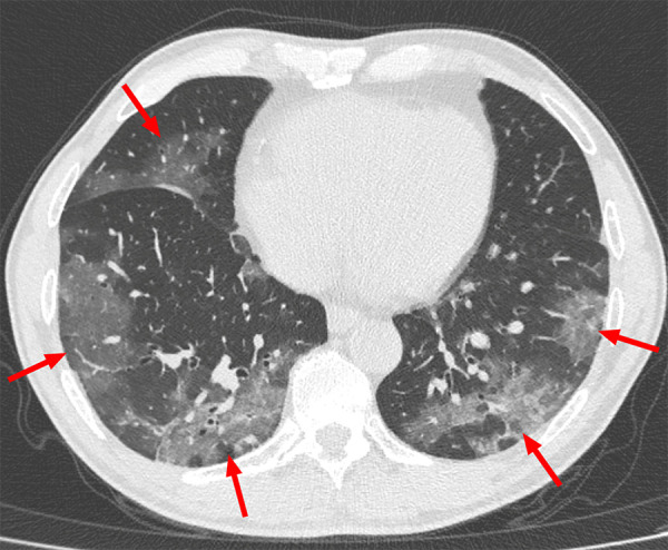 Example of typical CT imaging features for COVID-19 in a 55-year-old male patient. Chest CT image shows bilateral multifocal ground-glass opacities (arrows), which showed a posterior part/lower lobe predilection and mainly peripheral/subpleural distribution.