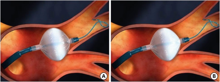 Cryoballoon Ablation for Atrial Fibrillation: a Comprehensive Review ...