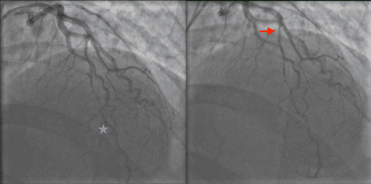 Spontaneous Coronary Artery Dissection Presenting As ST-Segment ...