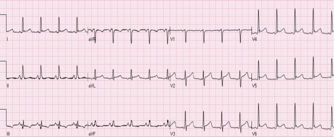 ST Elevation: Telling Pathology from the Benign Patterns - PMC