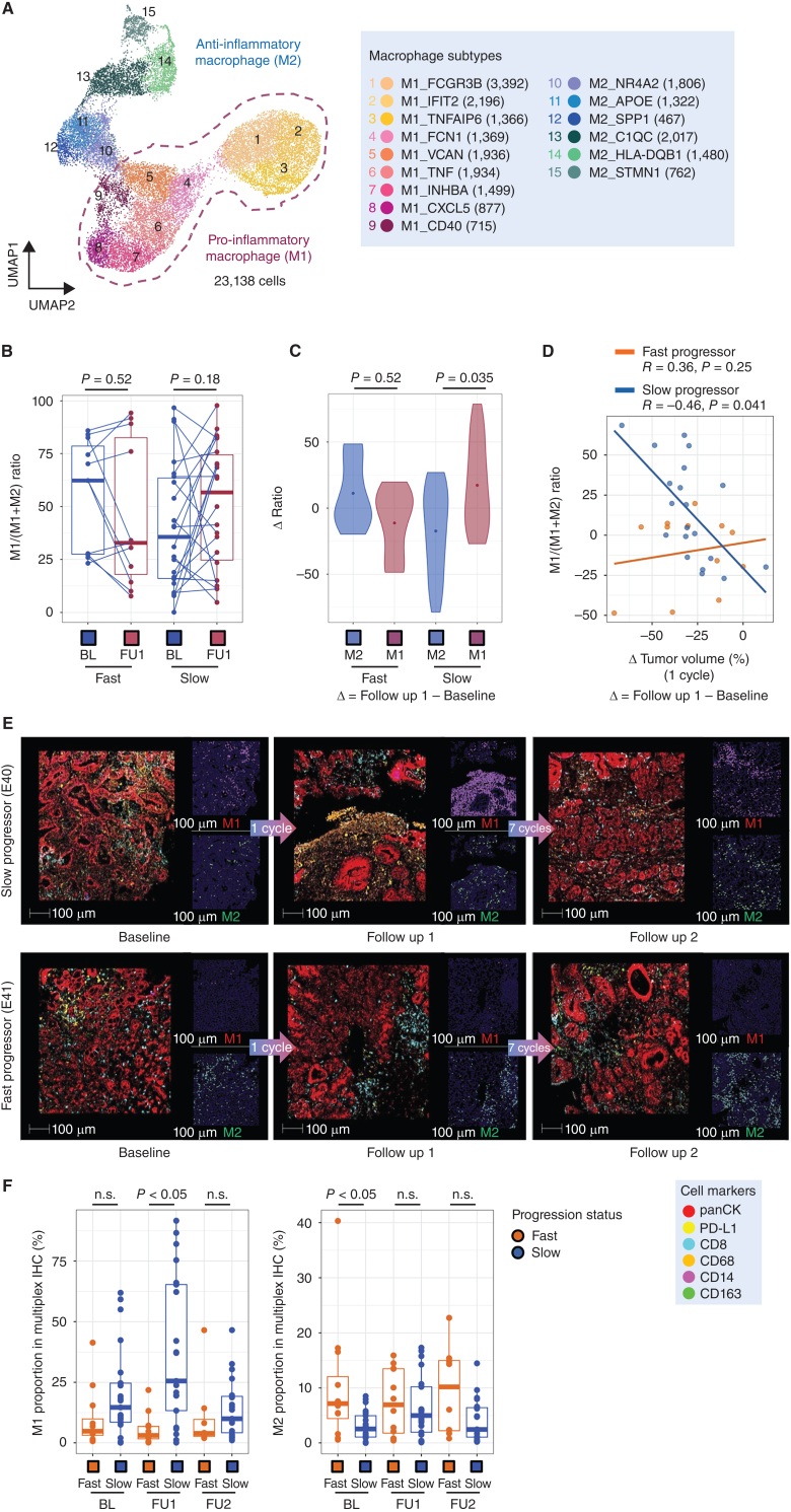 Figure 4. Chemotherapy leads to macrophage repolarization in patients with favorable responses. A, UMAP embedding of single-cell transcriptomes of all macrophages from all samples in this trial. Labeled are granular macrophage subtypes, including designation of M1 and M2 subtypes. B, Relative proportion of M1 macrophages of all macrophages, obtained from scRNAseq data, at BL and FU1 in fast and slow progressing patients. Statistical comparison performed using a Wilcoxon signed-rank test. C, Change in M1 and M2 macrophage proportions from BL to FU1, obtained from scRNAseq data, in fast and slow progressing patients. Statistical comparison performed using a Wilcoxon signed-rank test. D, Change in relative M1 proportion from BL to FU1 plotted against change in tumor volume after 1 cycle of chemotherapy, segregated by fast and slow progressing patients. E, Multiplexed immunofluorescence (mIF) images of BL, FU1 and FU2 samples from two patients, E40 (slow progressor) and E41 (fast progressor), staining for panCK, PD-L1, CD163, CD68, CD14 and CD8. F, Proportion of M1 macrophages, obtained from mIF images, at BL and FU1 in fast versus slow progressing patients. Statistical comparison performed using a Wilcoxon signed-rank test.