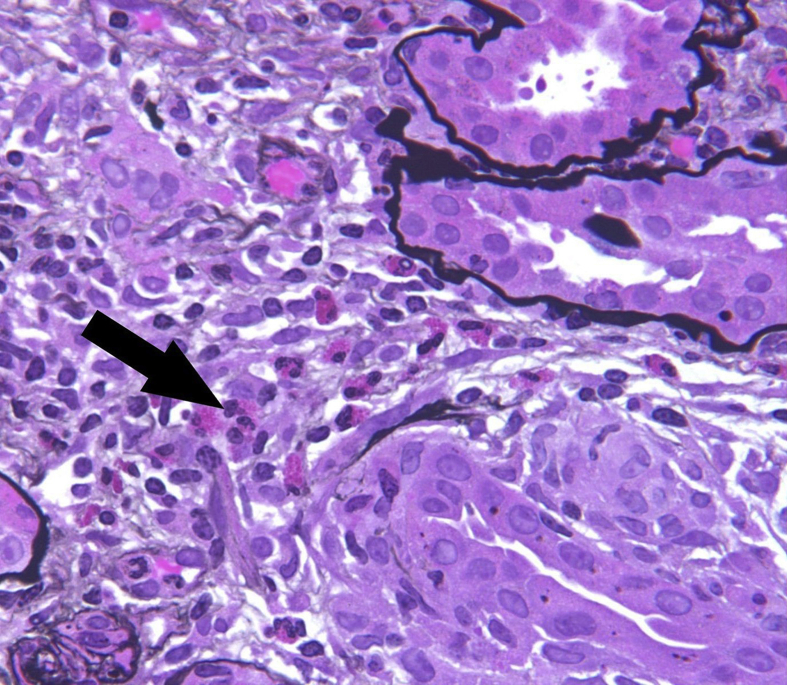 Educational Case: Renal Allograft Rejection - Pmc