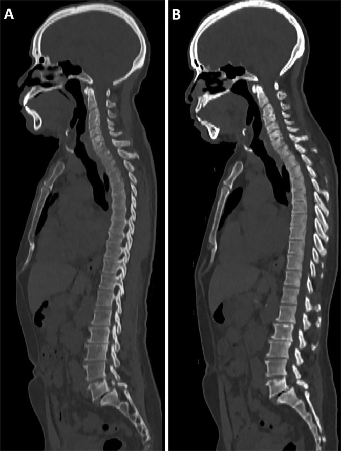 (A) Energy-integrating detector (EID) CT and (B) photon-counting CT (PCCT) images in a 61-year-old man with a body mass index of 28 kg/m2 and no multiple myeloma lesions. Dose-length product for this study was 1421 mGy·cm for EID and 213 mGy·cm for PCCT. Volume CT dose index was 9.04 mGy for EID and 1.47 mGy for PCCT.