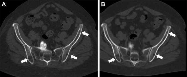 (A) Energy-integrating detector (EID) CT and (B) photon-counting CT (PCCT) images in a 71-year-old woman with a body mass index of 33 kg/m2 and multiple lytic multiple myeloma lesions (white arrows). Dose-length product for this study was 1608 mGy·cm for EID and 257 mGy·cm for PCCT. Volume CT dose index was 11.3 mGy for EID and 1.8 mGy for PCCT.