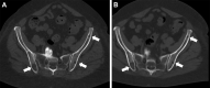 (A) Energy-integrating detector (EID) CT and (B) photon-counting CT
(PCCT) images in a 71-year-old woman with a body mass index of 33 kg/m2 and
multiple lytic multiple myeloma lesions (white arrows). Dose-length product
for this study was 1608 mGy·cm for EID and 257 mGy·cm for
PCCT. Volume CT dose index was 11.3 mGy for EID and 1.8 mGy for
PCCT.