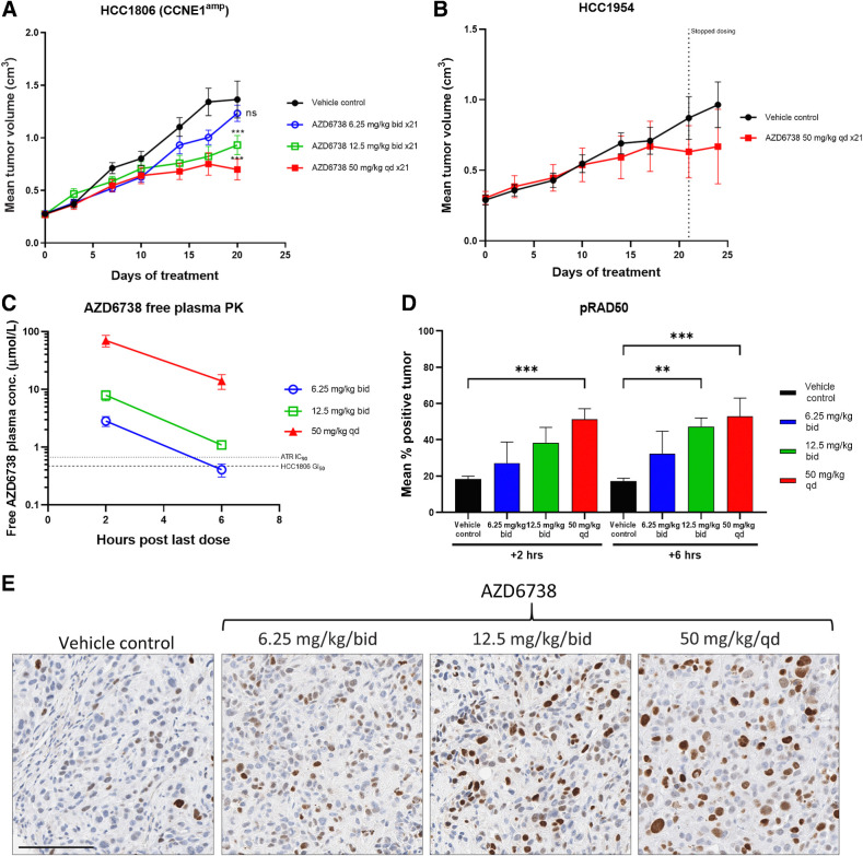 Figure 3. Antitumor in vivo efficacy breast cancer cell line xenograft models. A and B, HCC1806 harboring cyclin E amplification (A) and WT control HCC1954 xenografts (B). AZD6738 was dosed at the indicated duration and doses either once daily (qd) or twice daily (bid). Mean tumor volume ± SEM are shown. End-of-efficacy (day 21) plasma pharmacokinetics (PK) and tumor pharmacodynamics were assessed for HCC1806. C, Free plasma AZD6738 concentration (PK) plotted against dose at 2 or 6 hours after last AZD6738 dose. D, Pharmacodynamics IHC quantification of percentage of tumor cells positive for pRAD50 Ser635 at 2 or 6 hours post last AZD6738 or vehicle dose. Mean percentage of positive staining nuclei plus SD is shown. E, Representative images of the IHC pRAD50 expression 2 hours post last dose. ns, nonsignificant; **, P ≤ 0.01; ***, P ≤ 0.001.