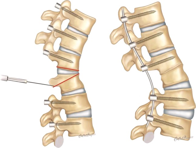 Osteotomies/spinal column resections in adult deformity - PMC