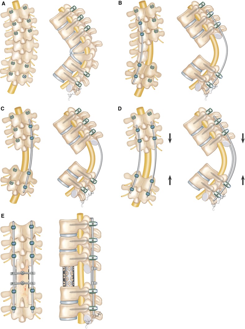 Osteotomies/spinal column resections in adult deformity - PMC