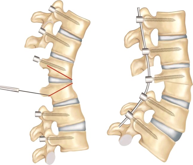 Osteotomies/spinal column resections in adult deformity - PMC