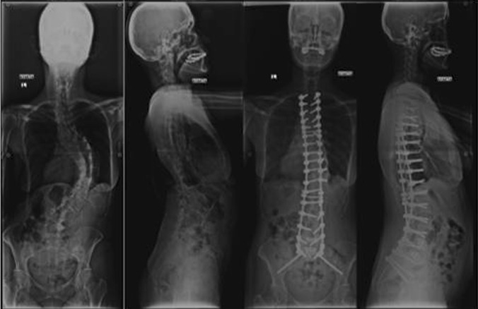 Osteotomies/spinal column resections in adult deformity - PMC