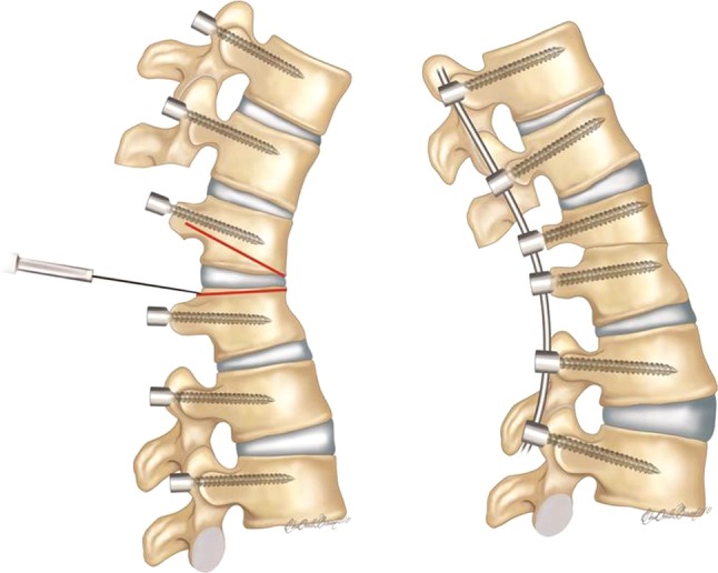 Osteotomies/spinal column resections in adult deformity - PMC