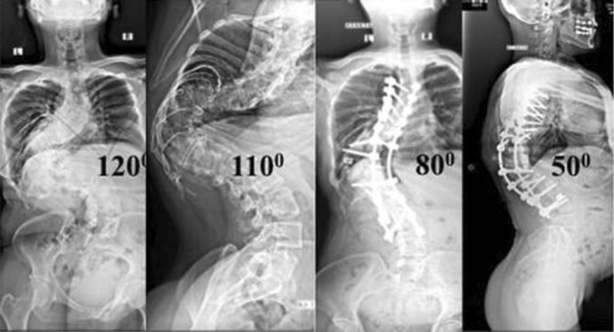 Osteotomies/spinal column resections in adult deformity - PMC