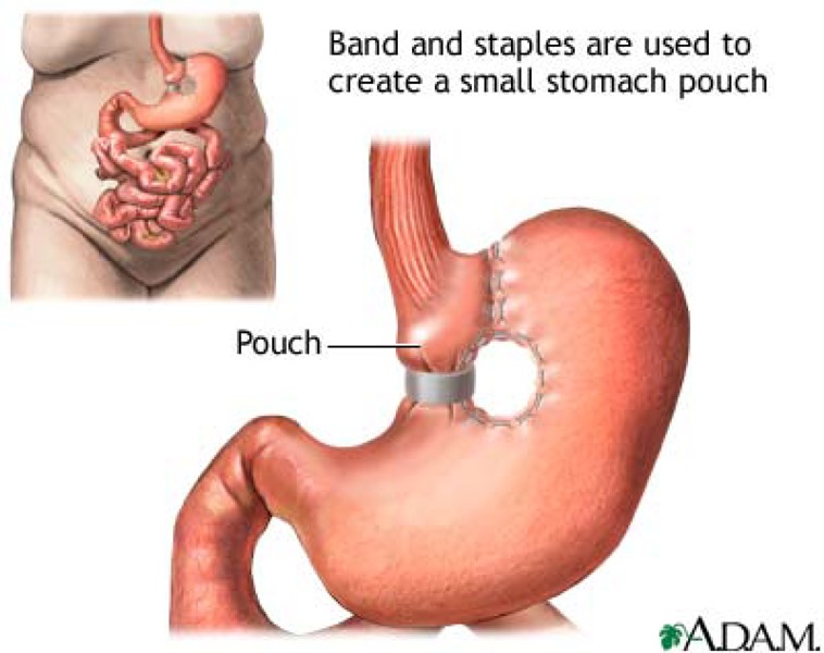 Vertical Banded Gastroplasty