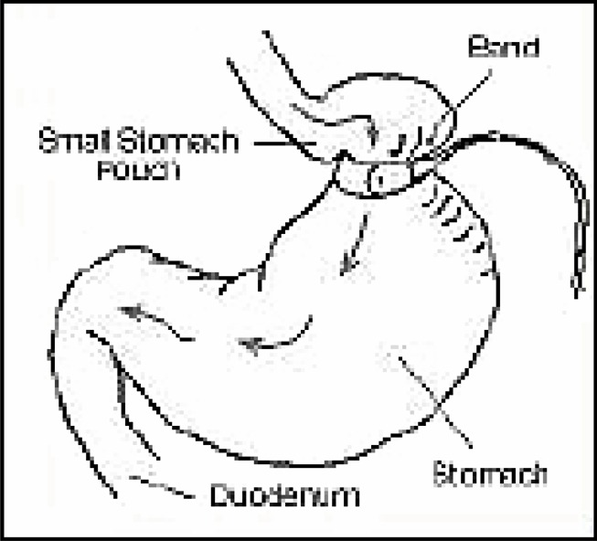 Adjustable Gastric Banding