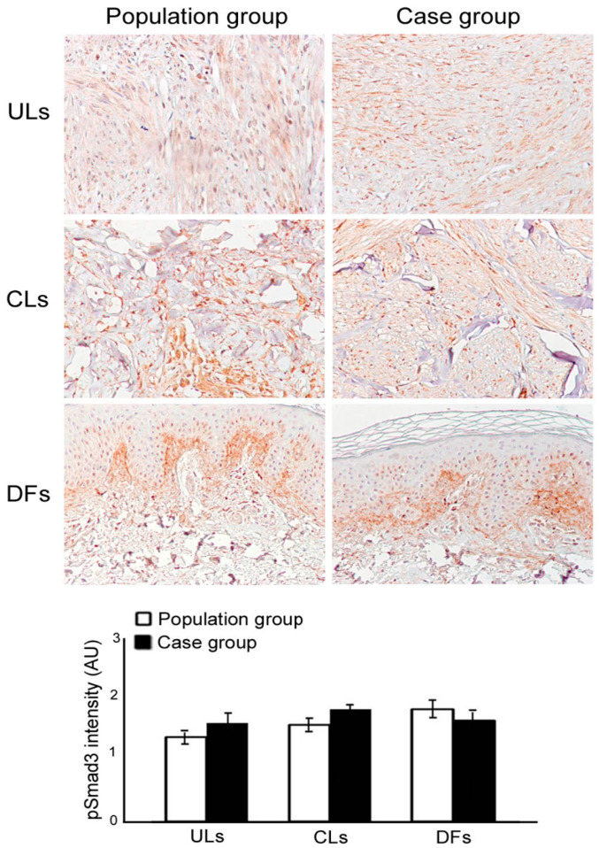 Increased Occurrence of Cutaneous Leiomyomas and Dermatofibromas in ...