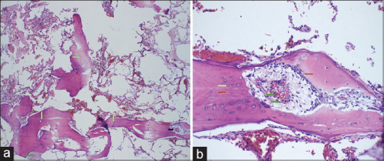 Dendriform pulmonary ossification in a patient with sickle cell disease ...