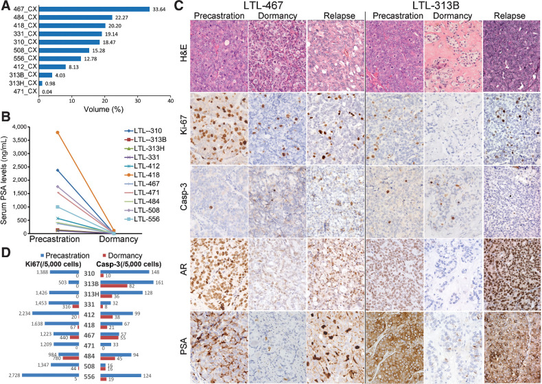 Figure 1. At week 12 after host castration, dormant prostate cancers were induced in PDXs. A, Percentage volumes of dormant (CX) PDXs at 12 weeks postcastration relative to the PDX volumes before host castration (mean ± SD = 11.65% ± 11.18%). B, Serum PSA of the hosts dropped to undetectable levels on day 84 (week 12) after castration. C, Representative images of H&E and IHC in precastration, dormancy, and relapsed prostate cancer PDXs. D, Ki-67 and caspase-3 (cleaved) percentages in precastration and dormant (at 12 weeks postcastration) PDXs. Casp-3, cleaved caspase-3.