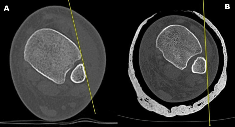 Computed Tomography Scan Architectural Measurements in Adult Foot and ...