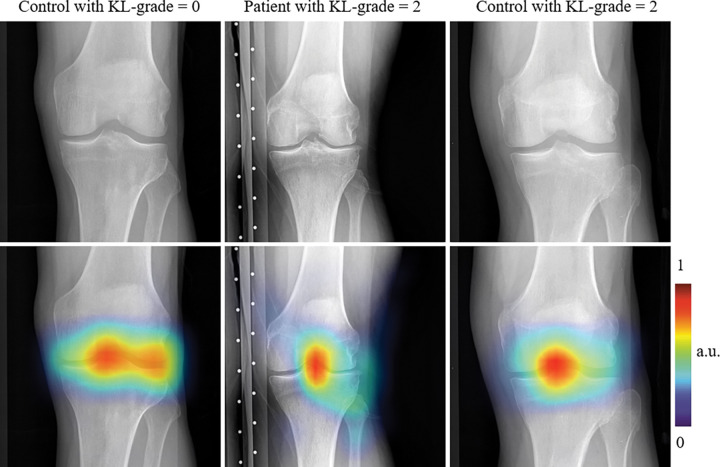 Knee radiographs overlaid with the heatmaps obtained by using the Grad-CAM method (27) (Appendix E1 [online]) show regions affecting the prediction of the multitask deep learning (DL) model trained with transfer learning. Colored regions show areas where multitask DL model trained with transfer learning focuses on decisions regarding the probability of total knee replacement in the patient within 9 years. Each column represents radiographs and heatmaps from a 75-year-old male control patient with Kellgren-Lawrence (KL) grade 0 (top and bottom left; body mass index [BMI], 26.0 kg/m2), a 76-year-old female control patient with KL grade 2 (top and bottom middle; BMI, 28.4 kg/m2), and a 70-year-old male patient with KL grade 2 (top and bottom middle; BMI, 27.6 kg/m2). Patients underwent total knee replacement and control patients did not undergo total knee replacement within 9 years.