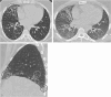 Inspiratory (A) axial and (C) sagittal CT images in the lung window in
a 28-year-old man show basilar and peribronchovascular predominant
ground-glass opacity (black circles, A and C) and subtle traction
bronchiectasis (arrow, A) with nonprofuse ground-glass nodularity (white
circles, A and C). (B) There is no air trapping on the expiratory axial CT
image. Diagnostic patterns were compatible hypersensitivity pneumonitis per
ACCP and indeterminate hypersensitivity pneumonitis per ATS/JRS/ALAT
guidelines. A higher level of confidence could not be reached with
ATS/JRS/ALAT given lower lobe distribution of nonprofuse ground-glass
opacity in a nonusual interstitial pneumonia pattern. A diagnosis of
connective tissue disease–interstitial lung disease was made during
multidisciplinary discussion. ACCP = American College of Chest Physicians,
ATS/JRS/ALAT = American Thoracic Society/Japanese Respiratory Society/
Asociación Latinoamericana del Tórax.