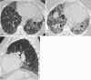 (A) Inspiratory axial, (B) expiratory axial, and (C) sagittal CT
images in a lung window in a 61-year-old woman show lower lobe predominant
ground-glass opacity with reticulation (dashed circles, A and C), traction
bronchiectasis (long arrows, A and C), and subpleural reticulation with
honeycombing (arrowheads, A) (short arrow, C). Inspiratory mosaicism (white
circle, A) is associated with air trapping on expiratory axial CT image
(white circles, B). The combination of ground-glass opacity indicative of
infiltration and fibrosis, mosaicism indicative of air trapping, and
intervening normal parenchymal attenuation constitute the three-attenuation
pattern. Diagnostic patterns were typical hypersensitivity pneumonitis per
ACCP and compatible hypersensitivity pneumonitis per ATS/JRS/ALAT
guidelines. A higher level of confidence could not be reached with
ATS/JRS/ALAT given lower lobe predominance. A diagnosis of fibrotic
hypersensitivity pneumonitis was made during multidisciplinary discussion.
ACCP = American College of Chest Physicians, ATS/JRS/ALAT = American
Thoracic Society/Japanese Respiratory Society/Asociación
Latinoamericana del Tórax.