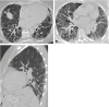 Inspiratory (A) axial and (C) sagittal CT images in the lung window in
a 76-year-old woman show lower lung and peripheral predominant reticulation
(circle, A and C) and traction bronchiectasis (arrow, A). (B) Expiratory
axial CT image shows air trapping (dashed circle, B). Diagnostic patterns
were typical hypersensitivity pneumonitis per ACCP and compatible
hypersensitivity pneumonitis per ATS/JRS/ALAT guidelines. A higher level of
confidence could not be reached with ATS/JRS/ALAT given lower lobe
distribution. A diagnosis of fibrotic hypersensitivity pneumonitis was made
during multidisciplinary discussion. ACCP = American College of Chest
Physicians, ATS/JRS/ALAT = American Thoracic Society/Japanese Respiratory
Society/Asociación Latinoamericana del Tórax.