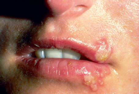 Figure: Herpes labialis