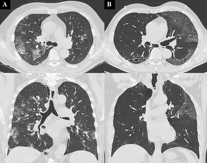 Images show chest CT features of patients with true-positive and false-positive results. A, In a 60-year-old man with bilateral diffuse areas of consolidation associated with ground-glass opacity (GGO), chest CT was classified as coronavirus disease 2019 (COVID-19) Reporting and Data System (CO-RADS) category 5 and as typical with Society of Thoracic Radiology/Radiological Society of North America (STR/RSNA) probability score, with subsequent confirmed diagnosis of COVID-19 based on fluid obtained at bronchoalveolar lavage (BAL). B, In a 54-year-old man with bilateral peripheral patchy areas of GGO who was hospitalized but not treated for COVID-19, an alternative diagnosis of viral pneumonia due to metapneumovirus was determined after BAL. Chest CT was classified as CO-RADS category 4 and as indeterminate with STR/RSNA probability score.