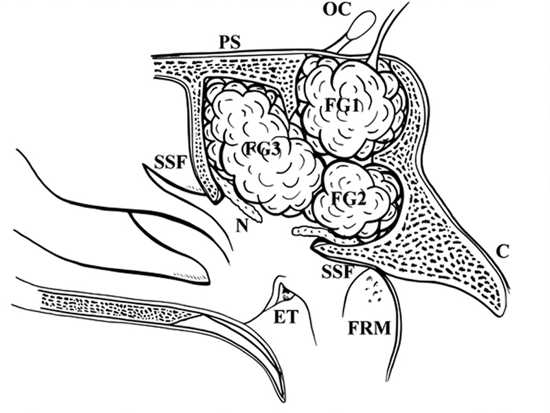 Fat in the Fossa and the Sphenoid Sinus: A Simple and Effective ...