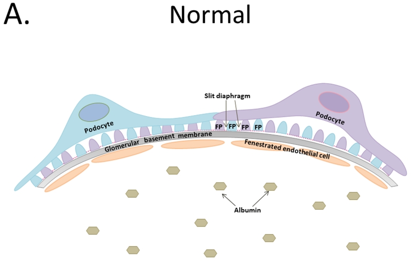 Podocytes: The Weakest Link in Diabetic Kidney Disease? - PMC