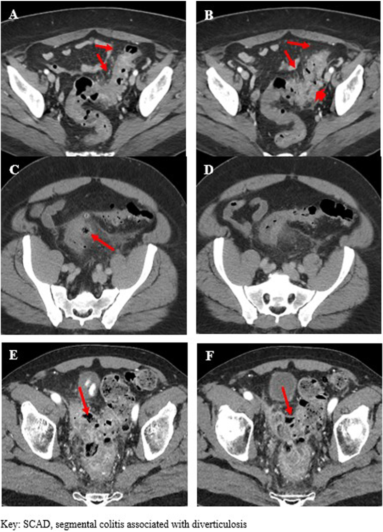Clinical and radiographic characteristics in segmental colitis