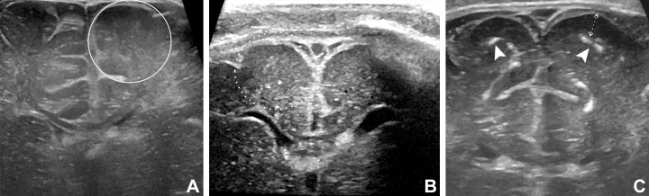 Spectrum of malformations of cortical development in infants exposed to Zika virus. Coronal cranial US scans at level of frontal lobes in three different Zika virus–exposed infants with Zika virus–like pattern. (A) Cranial US scan in 26-day-old boy with normal head size. Asymmetry of cerebral hemispheres is shown, smaller on left side. Paucity of sulcation on left side is shown, and thickening of cortex and loss of differentiation between cortical ribbon and subcortical white matter (circle) are consistent with malformation of cortical development. Right side is normal in this infant. (B) Cranial US scan in 7-day-old girl with microcephaly. Small and smooth appearance of frontal lobes and malformation of cortical development with paucity of sulcation and diffuse cortical thickening (dotted circle) are shown. No calcification is seen. Frontal horns of lateral ventricles are dysmorphic, and there is also ventriculomegaly (not shown). (C) Cranial US scan in 107-day-old boy with bilateral malformations of cortical development and coarse subcortical calcifications (arrowheads). Note thickening of cerebral cortex (double-headed arrow).